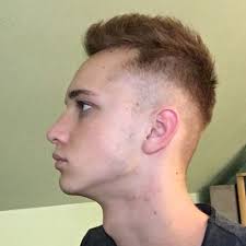 geheimratsecken mit 17 gesundheit haare korper