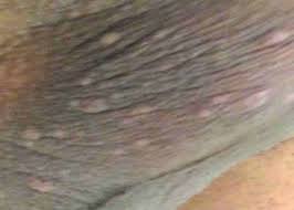 Lesiones Eczematosas Agravadas Con El Estres Dermatologo Net
