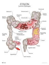 While hemorrhoids aren't the usual cause, as you pointed out, they're both internal and external hemorrhoids, my understanding is that the external hemorrhoids can be painful. Colon Cancer And Hemorrhoid Treatment Options Tcrs