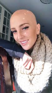 GALERIE: Doma se nestydím, ale ven nosím paruku, říká krásná dívka s  alopecií