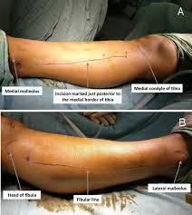 Image result for Compartment Syndrome