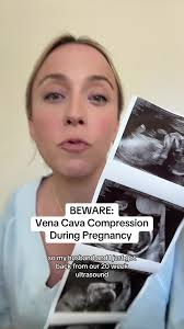 Understanding Vena Cava Compression During Pregnancy