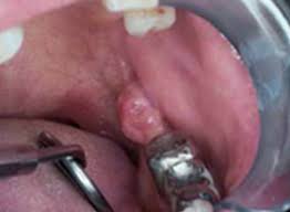 Any working part of the mouth can get affected by oral cancer including your gums, teeth, lips, roof of mouth, floor of the mouth located under the tongue, tissue lining your cheeks, lips and throat. Oral Cancer Images The Oral Cancer Foundation