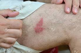 | piqure d aoutat vs. Rougeurs De La Peau Sur Une Jambe A La Suite D Une Piqure D Insecte Inconnu Probablement Une Guepe Banque D Images Et Photos Libres De Droits Image 65719817