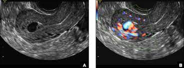 If you require medical attention and cannot return to your abortion provider for care, ask for the best place to go in your area. A Woman With Heavy Noncyclical Bleeding 6 Weeks After Abortion Mdedge Obgyn