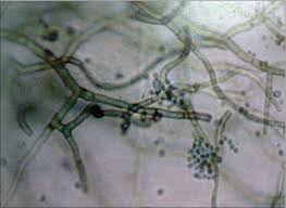 Pedrosoi, is also neurotropic, being. Indian Journal Of Dermatology Venereology And Leprology Chromoblastomycosis In Kerala India