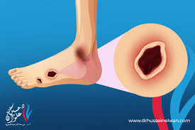 افضل طريقة لـ علاج جروح القدم لمرضى السكري دكتور حسين علوان