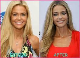 Pin On Breast Augmentation