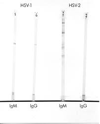 I was tested positive but then received an inhibition elisa test that said it was a false positive. Is Hsv Serology Useful For The Management Of First Episode Genital Herpes Sexually Transmitted Infections