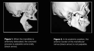 Image result for Jaw Dislocation
