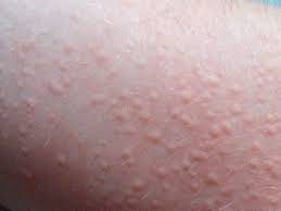 Biang keringat sering disebut dengan miliaria, yaitu gangguan pada kulit yang berupa ruam berbenjol di kulit badan , gatal. Ruam Kulit Setelah Olahraga Mungkin Kamu Kena Cholinergic Urticaria