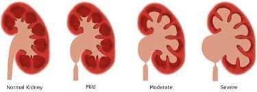 Weill Cornell Perinatal Center Pediatric Urology Urinarios Rinones Aparatos