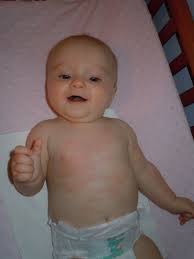 Lanwer Family Blog Sweet Potato Allergy Really