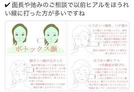 ボトックス顔