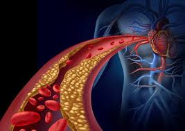 Image result for Hypercholesterolemia