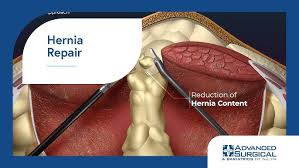 Image result for Hernia Reduction