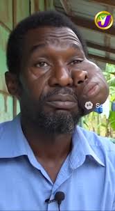 Man with Second Face at Kingston Public Hospital