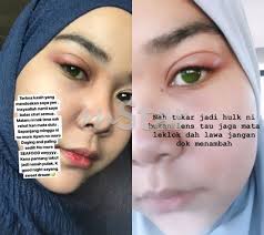 Sebenarnya ketumbit tiada kaitan langsung dengan tabiat mengintai kerana ia sejenis keradangan pada kelopak mata yang disebabkan oleh jangkitan kuman. Berpada Padalah Nak Cantik Punya Pasal Wanita Ini Berdepan Risiko Mata Kanannya Buta Dah Tukar Jadi Hulk Ni Viral Mstar