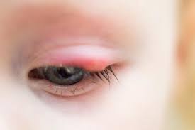 How To Prevent And Treat Styes: Abc Children's Eye Specialists:  Ophthalmologists