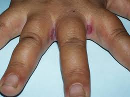 This rash is caused by a fungus or bacteria and can appear anywhere your skin rubs. Intertrigo Rashes In The Skin Folds Mdhairmixtress Com