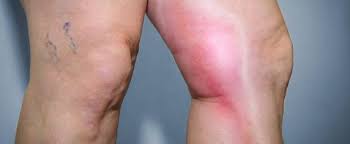 Dies geschieht in über 90 prozent der fälle im bein. Das Ist Der Unterschied Zwischen Thrombose Und Venenentzundung