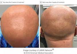 If you're concerned your hair isn't. Eczema Drug Restores Hair Growth In Patient With Longstanding Alopecia Eurekalert Science News