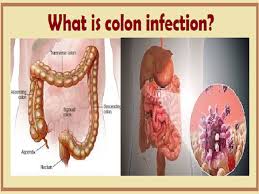 The colon often is incorrectly used in the meaning of the whole large intestine altogether; What Is Colon Infection