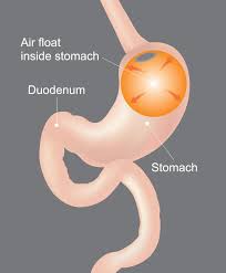 gastric balloon weight loss surgery for