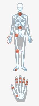 Arthrose und osteoporose sind heilbar! Arthrose Rheumaliga Schweiz