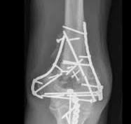 Distal Humerus Fractures - Trauma - Orthobullets