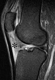 The test can show a range of. Layered Approach To The Anterior Knee Normal Anatomy And Disorders Associated With Anterior Knee Pain Radiographics