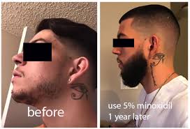 I'm actually getting sick of it and not applying twice daily like i was, mostly because i'm tired of it drying out my does anyone have a before/after picture of someone actually going from no beard to beard, as opposed to from no beard to scruff? Minoxidil Beard Growth Best Minoxidil Is Not Kirkland Or Rogaine