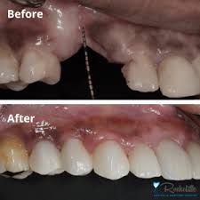 What to eat after tooth extraction and bone graft. Dental Bone Grafting Ottawa Rockcliffe Dental Denture Centre