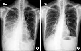 It does tell you that it's going to be more difficult to do a thoracentesis, to actually drain the fluid, and ultrasound is going to be much better at determining. A Chest Pa Before Treatment Loculated Right Pleural Effusion B Download Scientific Diagram