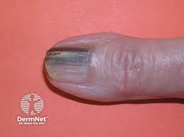 Image result for Acral lentiginous melanoma nail