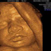 Praenatalschall de practice for prenatal diagnostics in munich. Die 3d 4d Ultraschall Untersuchung Ermoglicht Es Ein Plastisches 3d 4d Ultraschall Bild Ihres Kindes Zu Erstellen
