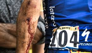 Las piernas de un ciclista tras 70 horas de una etapa del tour de francia por la cantidad de sangre que bombean durante el ejercicio. Asi Quedo La Pierna De Philippe Gilbert Tras La Caida En El Tour De France Ovacion 25 07 2018 El Pais Uruguay