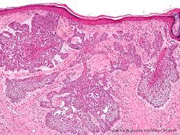 May 27, 2021, 6:14 am. Releasing The Immune System S Brakes Against Skin Cancer The Aacr