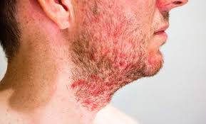 Image result for red rash face