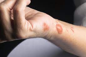 Burn Scars: Treatment, Removal, And Prevention