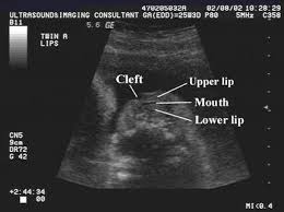 Ultrasound Of Cleft Lip And Palate Ultrasound Diagnostic Medical Sonography Obstetric Ultrasound