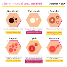 6 different types of acne explained beauty bay edited