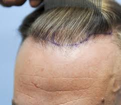 This is the basic reason why women spend a lot of time and money for grooming, dyeing, drying, curling and styling their hair. Best Hair Treatments In Delhi Best Clinic For Hair Problems In Delhi