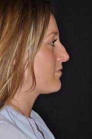 Before & After Rhinoplasty Palm Beach Gardens