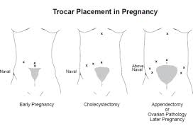 Surgical Mangement Of Ovarian Cysts Ovarian Cyst Treatment