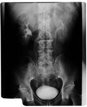 Yoga Poses For Overweight People Urinary Tract Infection Baking Soda Water Bladder Infection Remedies