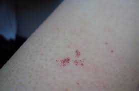 Mici pete roșii pe corp: Industrializa ReapÄƒrea Indura Pete Rosii Pe Maini Si Picioare Fara Mancarimi Butlercarriers Com