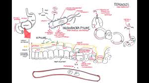 Microbiology Helicobacter Pylori Ulcer Youtube