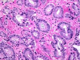 Not only are multiple genes involved in its pathogenesis, but additional environmental factors such as diet and inflammation are also involved. Webpathology Com A Collection Of Surgical Pathology Images