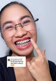 Ligtas Ba Ang White Power Chain sa Braces?